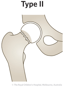 ED Section 1 FEMORAL NECK FRACTURE Type 2